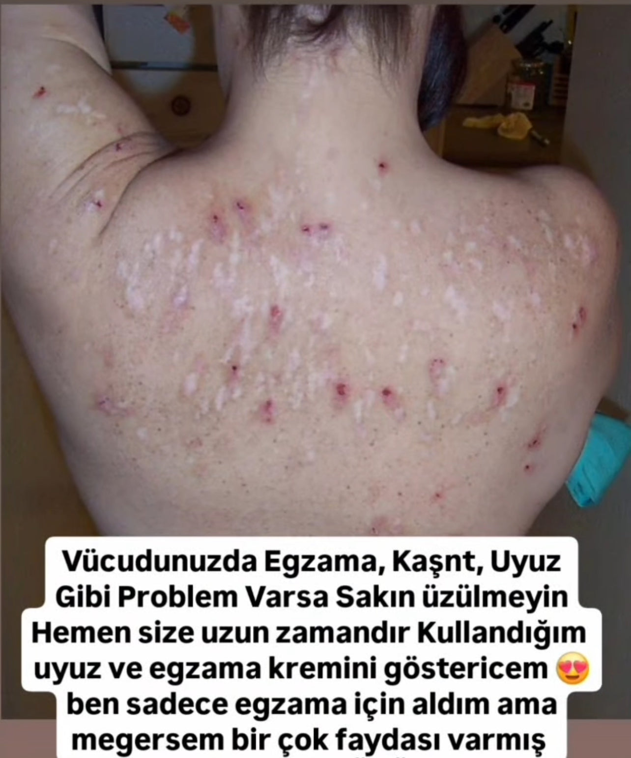Birobit krem, uyuz, kaşıntı, egzama gibi cilt sorunlarına karşı tedavi sağlayan bitkisel içerikli özel bir formüldür.